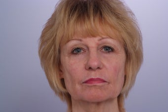 Laser Resurfacing