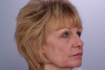 Laser Resurfacing