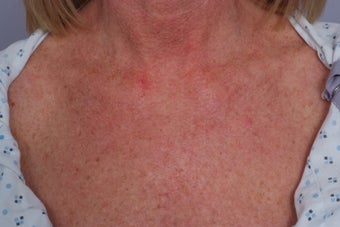 Laser treatment to Chest