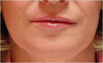 Smokers Lines Treatment