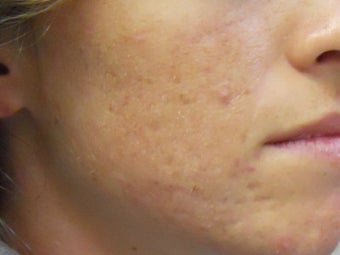 Acne Scars with Laser Resurfacing