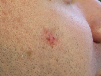 Acne scars treated with Punch Elevation of scars and Fractional Laser Resurfacing