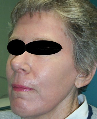 Full face laser resurfacing