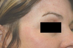 Crow's feet treatment