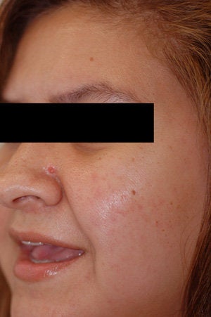 Laser Resurfacing