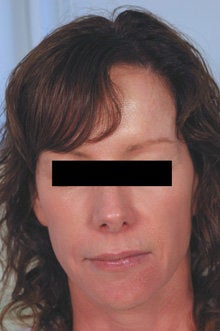 Laser Resurfacing