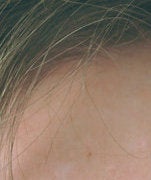 Laser treatments for Sebaceous Hyperplasia 