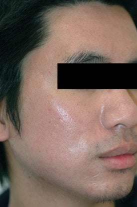 Laser Acne Treatment