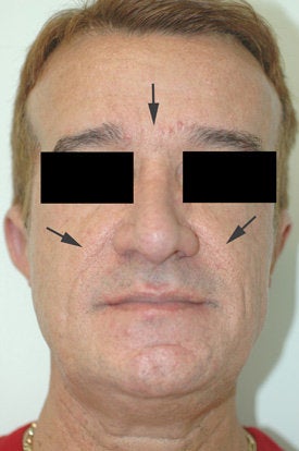 Botox and Restylane Treatment