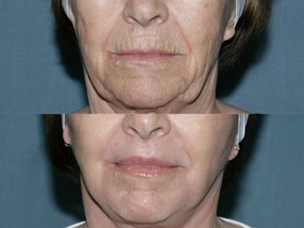 Fraxel repair on full face and neck with Erbium and CO2 lasers for upper lip wrinkles