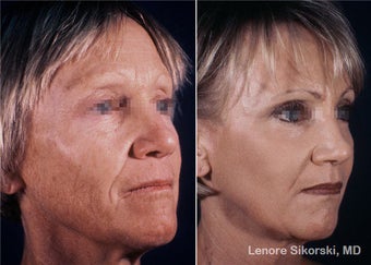 Full Face Laser Resurfacing and Upper Bleph