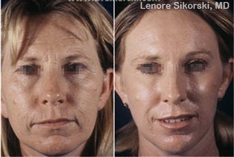 Laser Resurfacing