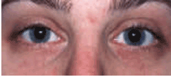Laser Resurfacing with Erbium laser