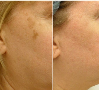 Fractionated resurfacing, QS Alexandrite laser, V-Beam laser