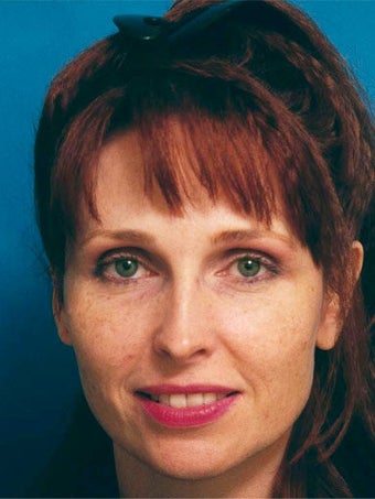 Full face erbium laser resurfacing
