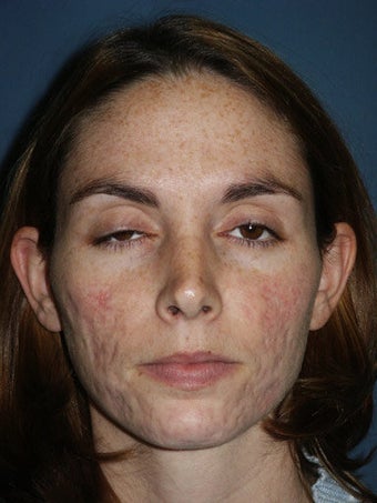 Full face erbium laser resurfacing