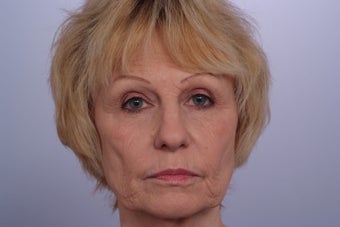 Laser Resurfacing