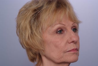Laser Resurfacing