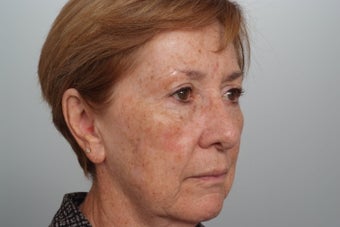 Fractionated CO2 laser resurfacing