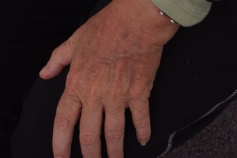 Fractionated CO2 laser resurfacing to hands