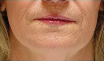 Smokers Lines Treatment
