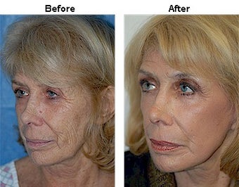 Laser wrinkle removal