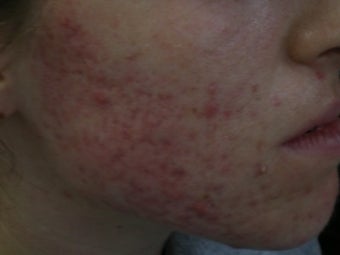 Acne Scars with Laser Resurfacing