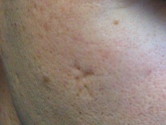 Acne scars treated with Punch Elevation of scars and Fractional Laser Resurfacing