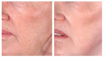 Wrinkle treatment near mouth