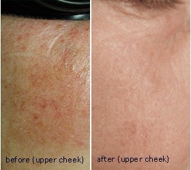 Laser therapy to correct melasma