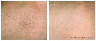 Spider veins on the leg treated with laser therapy