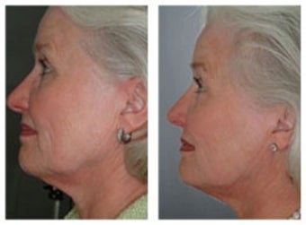 Skin tightening with laser therapy