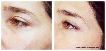 Laser skin resurfacing for crow's feet