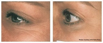 Laser skin resurfacing to crow's feet