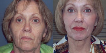 CO2 Laser skin resurfacing