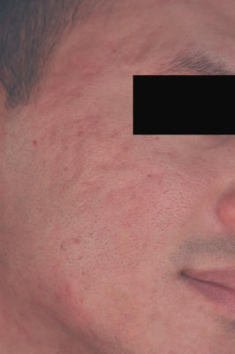 Laser Resurfacing for Acne Scars