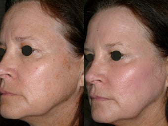 Juvia fractional CO2 resurfacing