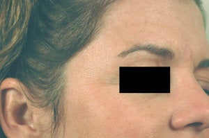 Crow's feet treatment