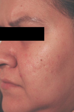 Laser Resurfacing