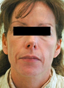 Laser Resurfacing