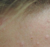 Laser treatments for Sebaceous Hyperplasia 