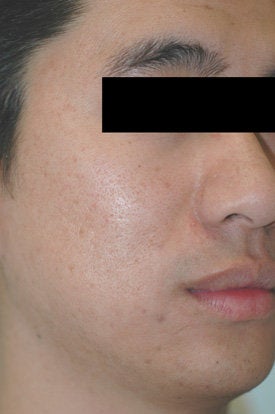 Laser Acne Treatment
