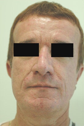Botox and Restylane Treatment