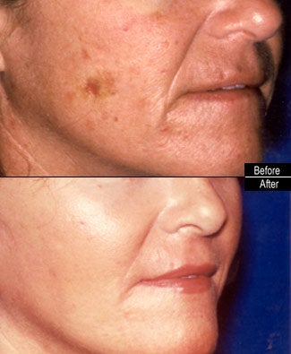 CO2 Laser Resurfacing