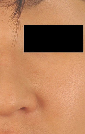 Laser Treatments for Spider Hemangioma 