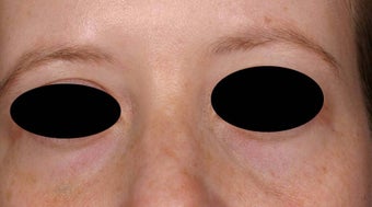 Blue veins around eyes