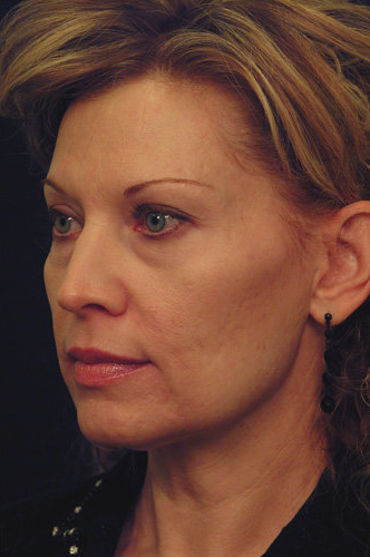 Yag Laser Skin Tightening