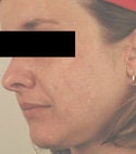 Acne Scar Removal 