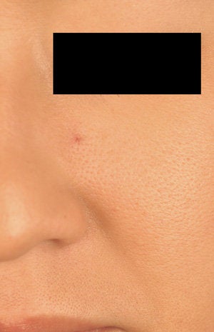 Laser Treatments for Spider Hemangioma 