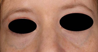 Blue veins around eyes